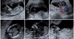 Doppler fetal exámenes prenatales